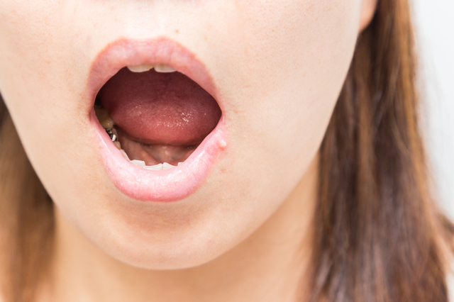 口内炎の種類と原因